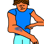 I've a bruise on my arm.
